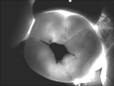 The DIFOTI system uses visible light to illuminate cracks and early caries.