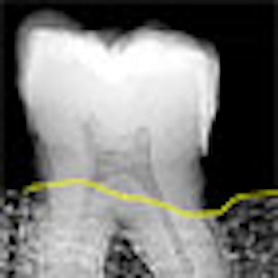 2008 10 02 17 02 55 979 Caries Detection