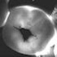 2009 03 09 16 33 36 409 2009 03 16 Caries Detection 70