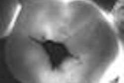 2009 03 09 16 33 36 409 2009 03 16 Caries Detection 70