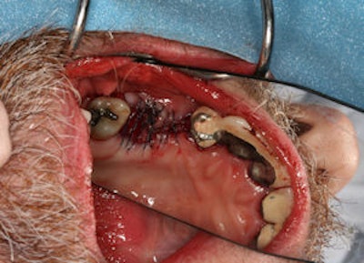 2009 03 30 16 08 22 844 2009 03 26 Toothregen2