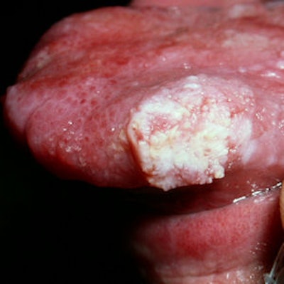 2009 05 19 12 22 42 314 2009 05 21 Squamous Cell Carcinoma