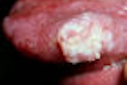 2009 05 19 12 22 42 851 2009 05 21 Squamous Cell Carcinoma Thumb