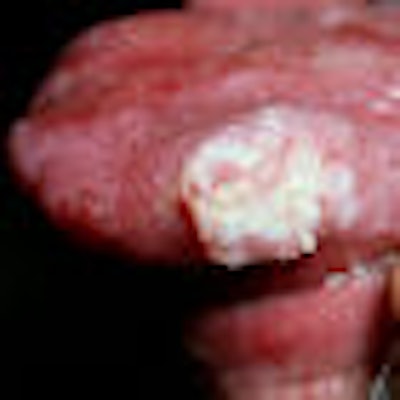 2009 05 19 12 22 42 851 2009 05 21 Squamous Cell Carcinoma Thumb
