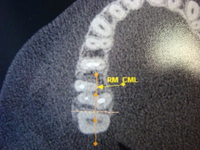 2009 06 19 16 17 58 408 2009 06 18 Occlusal Cbct
