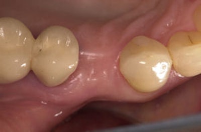 2009 07 07 12 12 23 116 Flapless Implant1