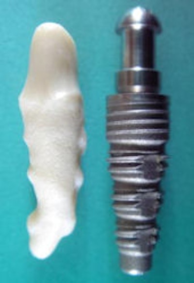 2009 08 07 13 47 50 242 2009 08 10 Zirconia Implant