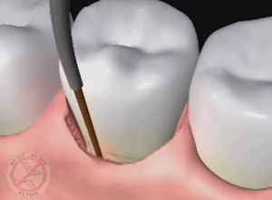 2009 08 18 11 33 55 404 2009 08 18 Lanap Occlusal