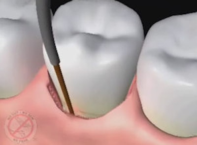 2009 08 18 11 33 55 404 2009 08 18 Lanap Occlusal