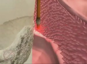 2009 08 18 11 44 15 723 2009 08 18 Lanap Debridement2