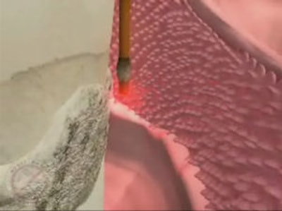 2009 08 18 11 44 15 723 2009 08 18 Lanap Debridement2