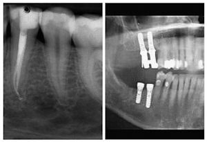 2009 08 31 09 20 54 695 Implants Endo