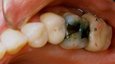 Is articulating paper the best tool for occlusal analysis