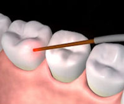 2009 10 08 16 25 37 650 Lanap Tooth Image 200