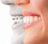 2009 01 30 11 56 34 729 Invisalign 70