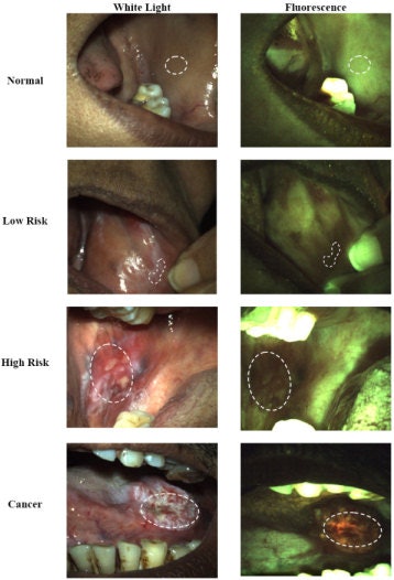 2010 05 11 11 39 53 765 2010 05 12 Oralcancer