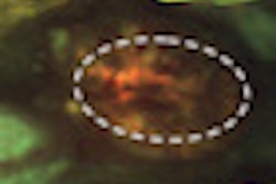 2010 05 11 15 43 13 0 2010 05 12 Oralcancer Thumb