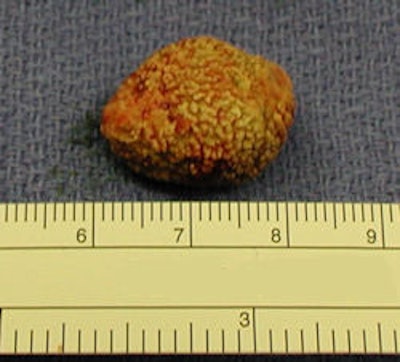 2010 05 19 14 35 56 512 2010 05 20 Salivarystone1