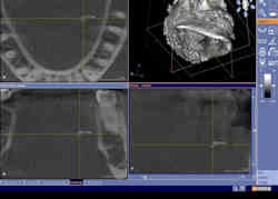 2010 07 06 13 44 32 380 2010 07 07 Cbct Salivary2 Thumb