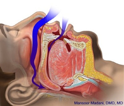 In obstructive sleep apnea, the upper airway is completely or partially blocked, often hundreds of times every night. This can lead to serious medical complications, increased risk of daytime car and work accidents, and even sudden death during sleep. Image courtesy of Mansoor Madani, D.M.D., M.D.