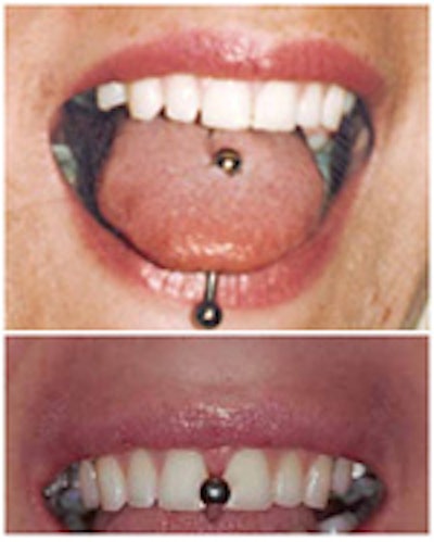 New studies highlight tongue piercing risks DrBicuspid