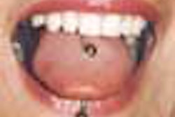 2010 08 11 09 24 37 479 Tongue Piercing Barbell 70
