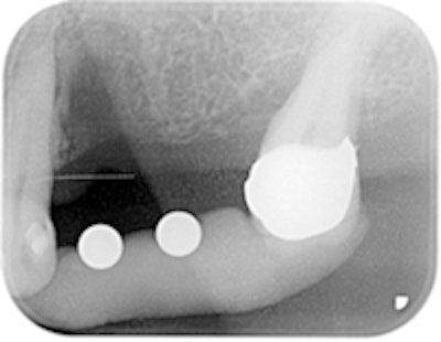 Figure 2: Radiograph with measuring balls.