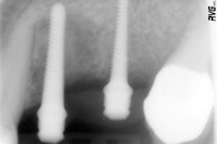 Figure 3 (top): An overview of the system's components, including the manual wrench.Figure 4 (bottom): Radiograph to control the proper position of the Spread-Condense screws.