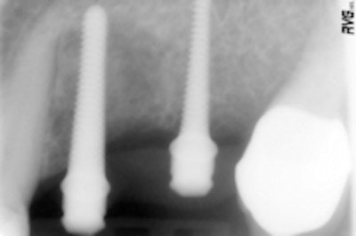 Figure 3 (top): An overview of the system's components, including the manual wrench.Figure 4 (bottom): Radiograph to control the proper position of the Spread-Condense screws.