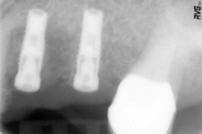 Figure 5 (top): The Spread-Condense screw is screwed in by means of the hand wrench. Figure 6 (bottom): Radiograph to control the implants after implantation.