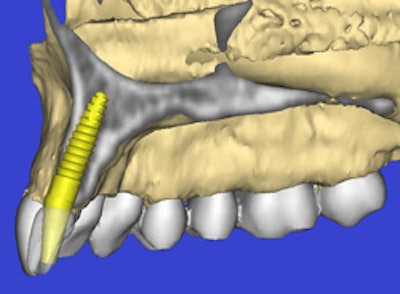 Cone-beam CT provides important radiographic, restorative, and surgical information for implant treatment planning, including implant trajectory, distribution, depth, and proximity to critical anatomical landmarks. All images courtesy of Scott Ganz, D.M.D.