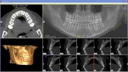 2010 08 27 13 05 52 389 2010 08 27 Cbct Implant2 Thumb