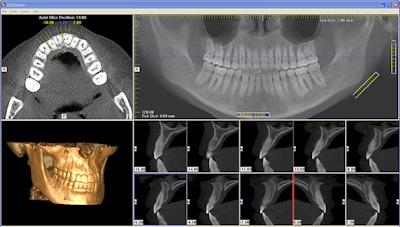 2010 08 27 13 05 52 674 2010 08 27 Cbct Implant2