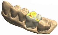 With the new 3Shape interface, restorations can be manufactured using 3M ESPE materials. Image courtesy of 3Shape.
