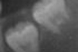2008 10 23 12 11 24 946 2008 10 23 3rd Molar Thumb