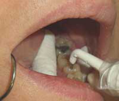 With the CarieScan Pro, the tooth is air-dried and the disposable tip is placed onto the tooth. Image courtesy of CarieScan.