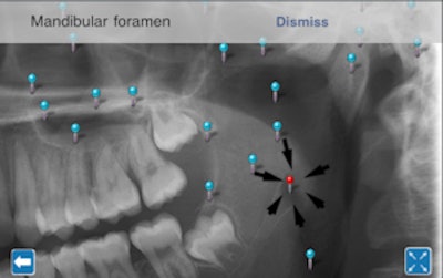 iPanoramic pinpoints key anatomical features in pano images.