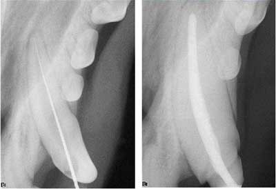 Figure 6A (left): Determining the working length. Figure 6B (right): Final obturation. Note crown prep margins evident in radiograph.