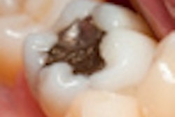 2010 12 16 10 52 48 75 Amalgam Filling 70