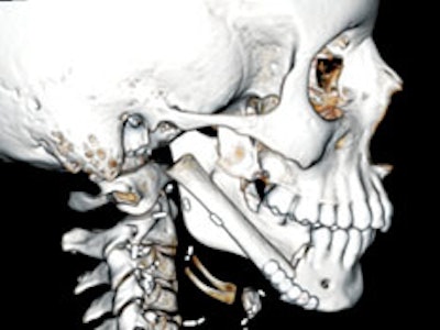 After surgery, a CT scan shows the rib segment that plastic surgeon Dr. Rohit Khosla transplanted to the jaw. Dr. Khosla also connected the rib's blood vessels during the surgery to encourage the transplant to grow in its new location.
