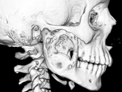 Before the unusual reconstructive surgery, CT scans showed the 12-year-old patient's jaw bone ballooning with a rare tumor. Images courtesy of Lucile Packard Children's Hospital.