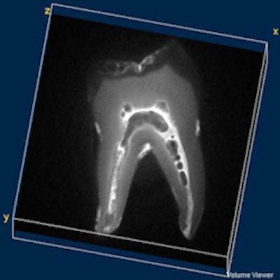 SWIFT, a novel MRI technique, can simultaneously image both hard and soft dental tissue. Image courtesy of Djaudat Idiyatullin, Curt Corum, and Steen Moeller (CMRR).