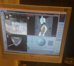 The Implant Guided Implant system from Image Navigation.