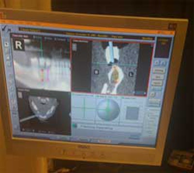 The Implant Guided Implant system from Image Navigation.