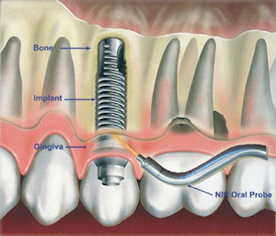 A proposed near-infrared oral probe can noninvasively assess peri-implantitis earlier and more accurately than conventional methods. Image courtesy of Kan-Zhi Liu, MD, PhD.