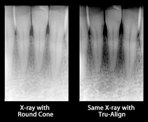 Tru-Align improves image quality by ensuring proper alignment, according to its developers. Left, an image taken using a round collimator; right, the same image taken with Tru-Align.