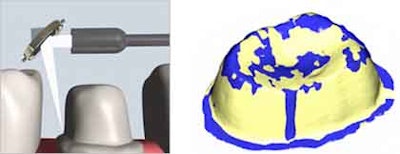 A schematic of the intraoral ultrasonic microscanner being developed at Aachen University. Image courtesy of RWTH Aachen.