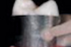 2011 07 11 09 27 00 655 2011 07 11 Glass Ionomer Thumb