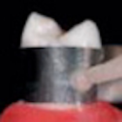 2011 07 11 09 27 00 655 2011 07 11 Glass Ionomer Thumb