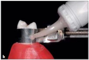 With The Matrix Band Tightly Fit At The Cervical Margin, Palatal/Lingual Access Is Allowed Through An Opening And Glass Ionomer Injected Into The Preparation